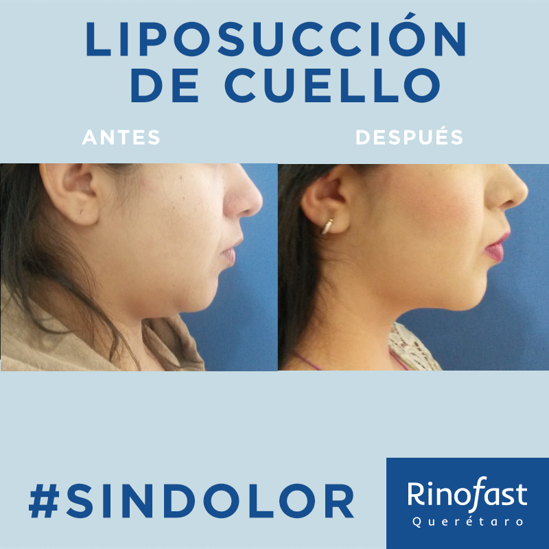 Antes y Después Liposucción de Cuello