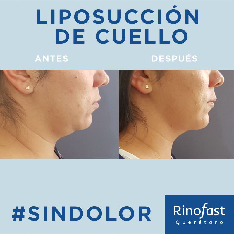 Antes y Después Liposucción de Cuello 4