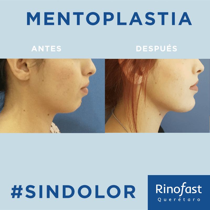 Antes y Después Mentoplastía 2