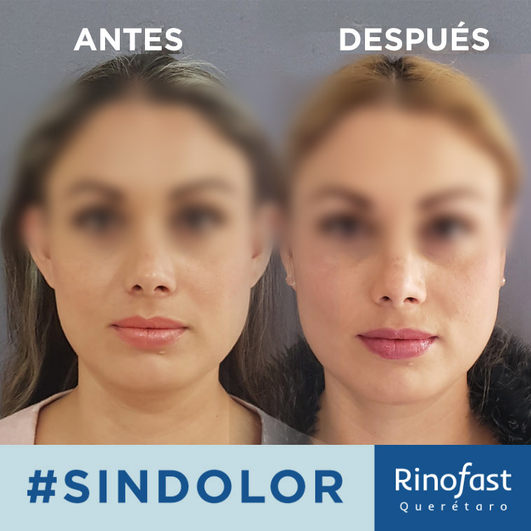 Antes y Después Otoplastia 2