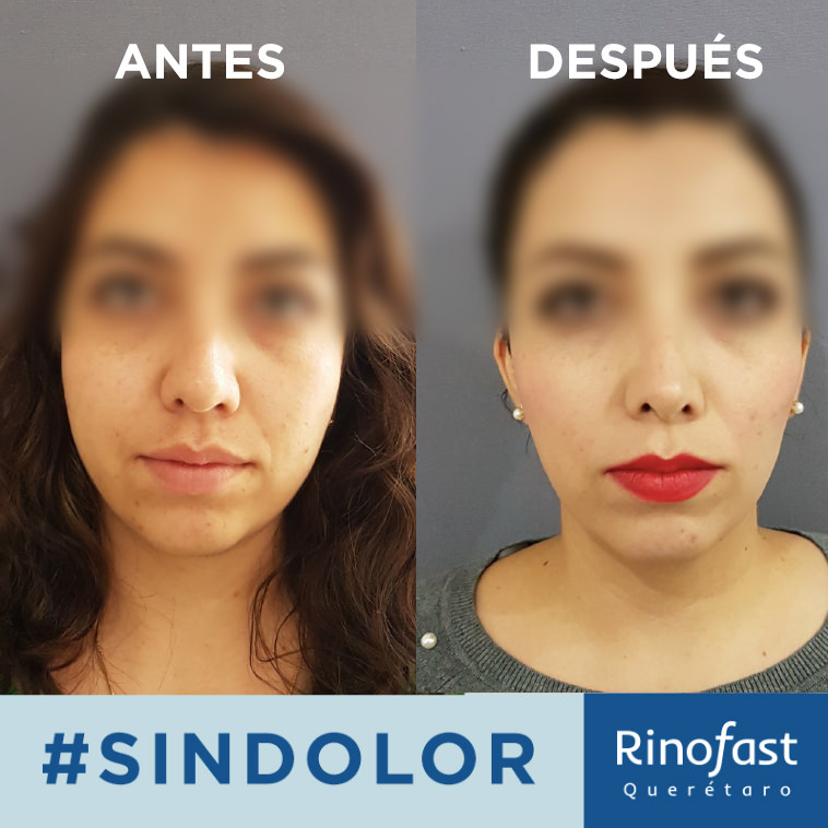 Antes y Después Rinoplastía 2