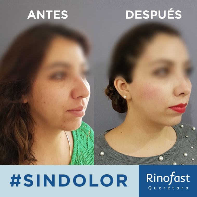 Antes y Después Rinoplastía 2