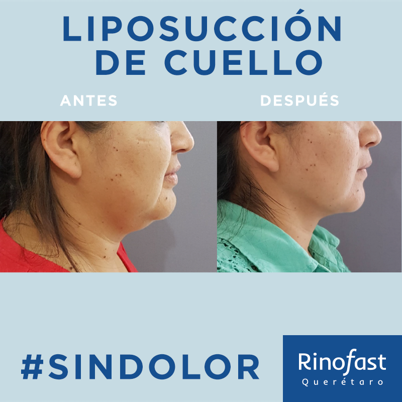 Antes y Después Liposucción de Cuello 3