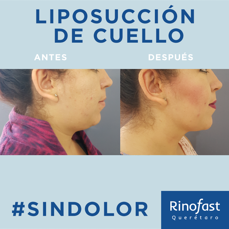 Antes y Después Liposucción de Cuello 2