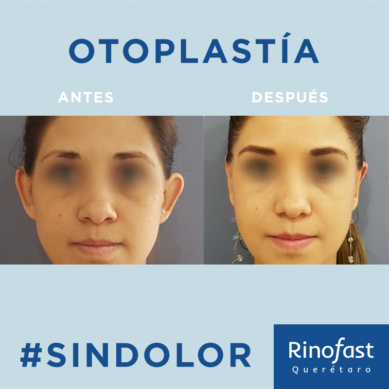 Antes y Después Otoplastia 1