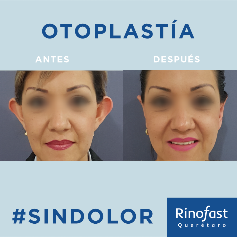 Antes y Después Otoplastia 2